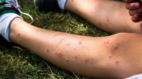 Insect venom allergy: symptoms and treatment | gesund.bund.de