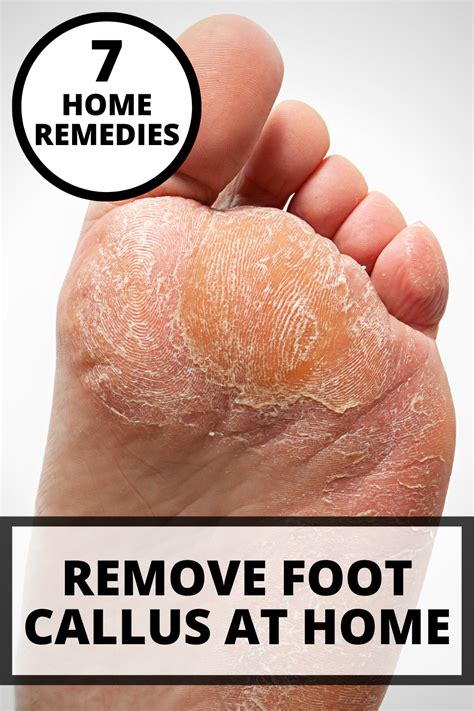 How To Remove Foot Callus At Home