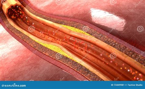 Plaque In Coronary Arteries