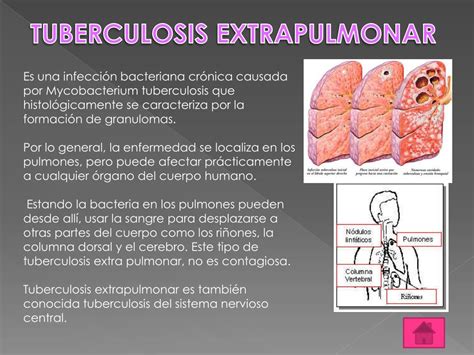 PPT - TUBERCULOSIS EXTRAPULMONAR PowerPoint Presentation, free download - ID:2345863