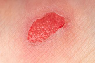 Granulation Tissue in Wound Care: Identification, Function, and Management | WoundSource