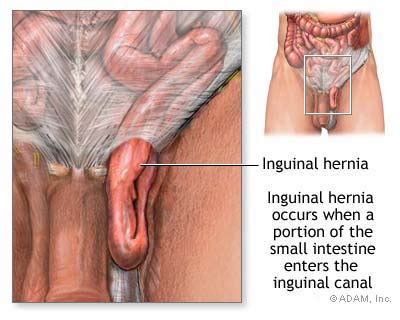 Left Abdominal Pain: Lower Left Abdominal Pain In Men Hernia