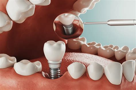 Can Dental Implants Be Done In One Day?