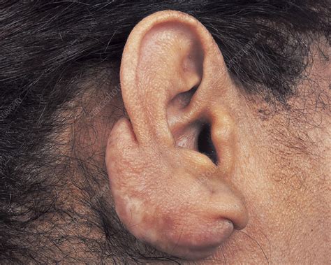 Keloid Ear