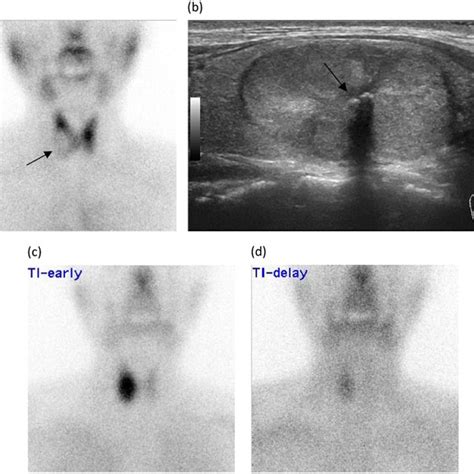 a A Tc-99m scintigraphy image showing a cold thyroid nodule (arrow) in... | Download Scientific ...