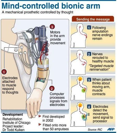 Infographic on Prosthetic Limbs