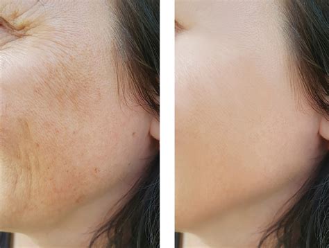 Skin Pigmentation Treatment - Gresford Laser Clinic : Gresford Laser Clinic