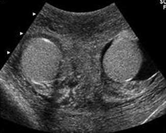 Scrotal Ultrasound | Radiology Key