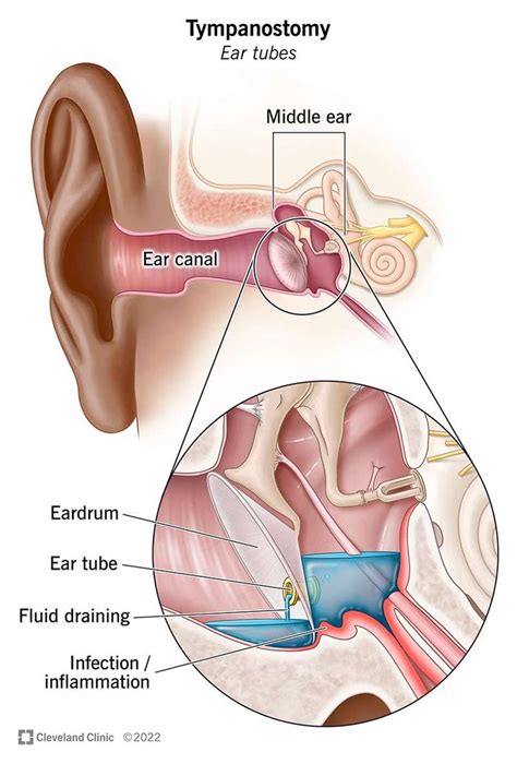 Ear Tubes (Tympanostomy): Definition & Procedure | Ear tubes, Basic anatomy and physiology, Ear ...