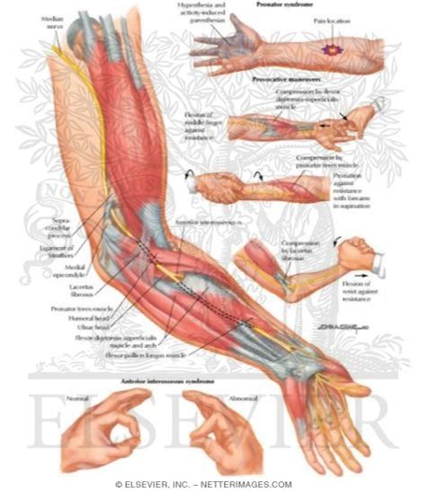 Nerve: Median Nerve Entrapment