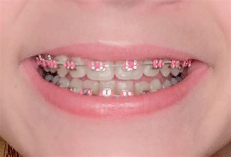 Pink Braces - What's The Right Color For You? - Fun Footer