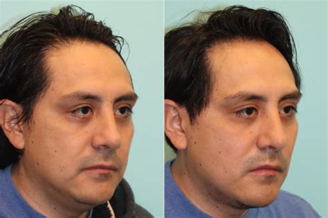 Submentoplasty before and after photos - The Naderi Center for Plastic ...