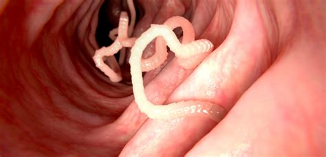 Tapeworms Pinworms Infection: Symptoms Treatment Tests & preventions