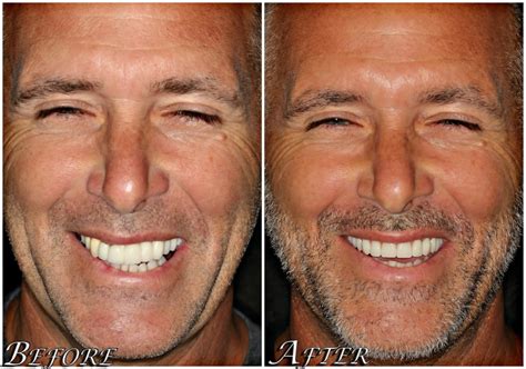 All on 4® Dental Implants Before and After Photos - Center 4 Smiles