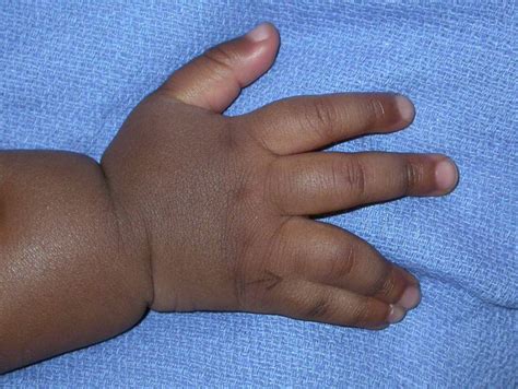 Syndactyly | Pediatric nursing, Nursing care, Pediatrics