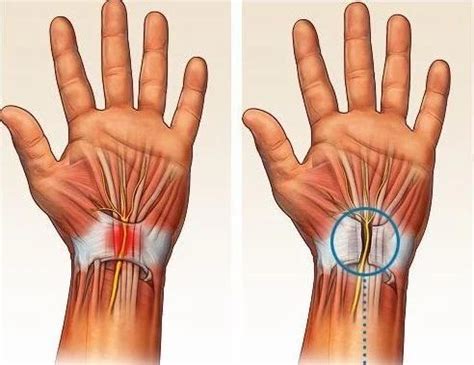 Carpal Tunnel Release Surgery at Rs 120000 in Raigad | ID: 10662863733