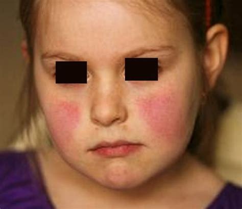Rash On Face Treatment Causes Pictures HubPages