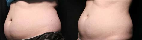 Vanquish - Painless, Non-Invasive Fat Reduction - Maryland