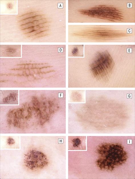 Dermoscopic Patterns of Acral Melanocytic Nevi and Melanomas in a White ...