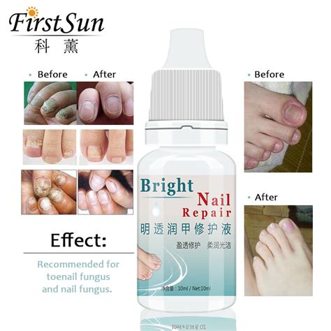 Firstsun Herbal Fungal Nail Repair Treatment Nail Nutrition Oil Nourish Nail Cuticle Oil Soften ...