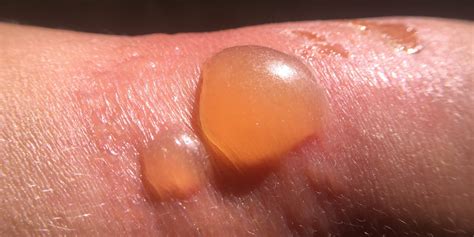 5 home remedies for sunburn blisters, according to a dermatologist