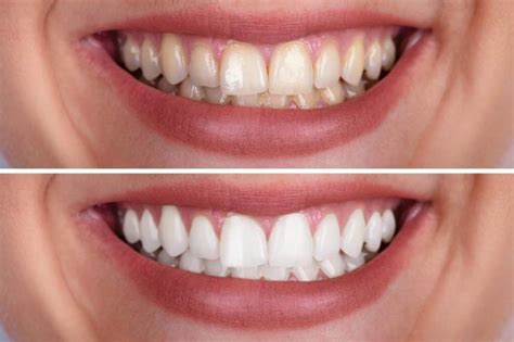 Teeth Whitening and How to Maintain Your White Teeth: Excellence in ...