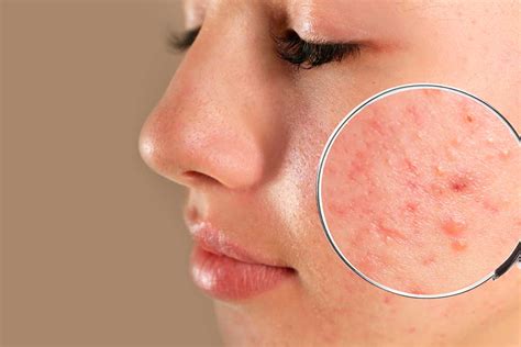 Is my acne 'Fungal Acne'? – SkinQ