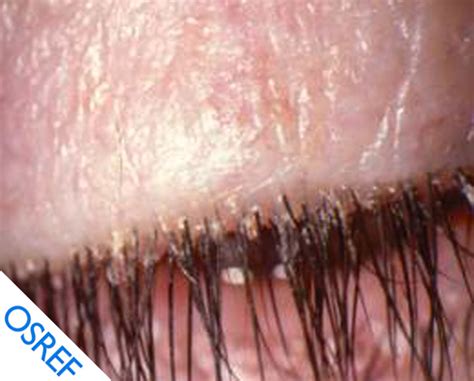 Demodex Blepharitis: Diagnosis and Treatment - Osref