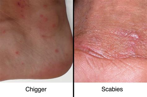 Chigger Bites vs. Scabies: How to Tell the Difference