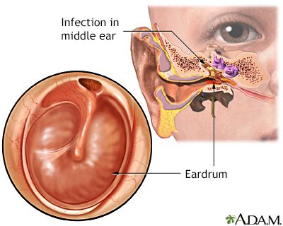 Chronic Ear Infection - Symptoms and Causes