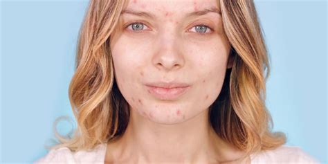 Why People Are Posting Acne Photos on Instagram - Skin Positivity