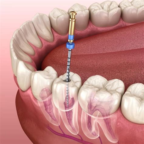 Root Canal Treatment: Timeframe, Procedure, and Recovery