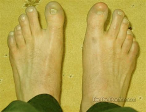 Chilblains Symptoms | Symptoms Causes Treatment and Prevention of Diseases