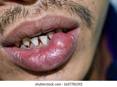 28 Mucocele Images, Stock Photos & Vectors | Shutterstock