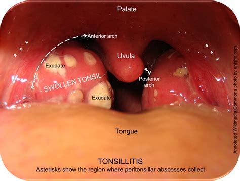 Peritonsillar Abscess (Quinsy) — entsho.com