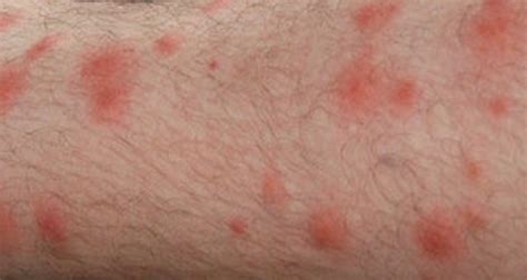 Chigger Bites – Pictures, Symptoms, Causes, Treatment – Inside the Clinic