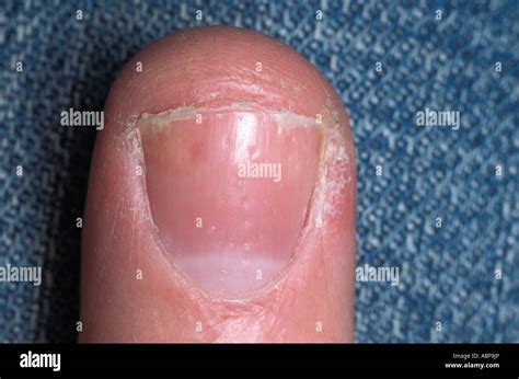 Nail psoriasis pitting hi-res stock photography and images - Alamy