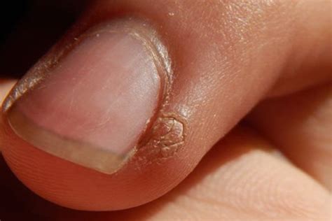 Fingernail & Toenail Warts - Fast Wart Remover