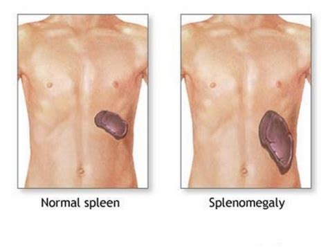 Splenomegaly Causes, Symptoms, Diagnosis and Treatment - Natural Health News