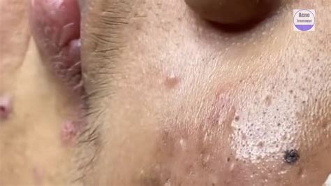 Extreme Blackhead Popping Youtube 2024 New Videos Youtube - Alfy Louisa