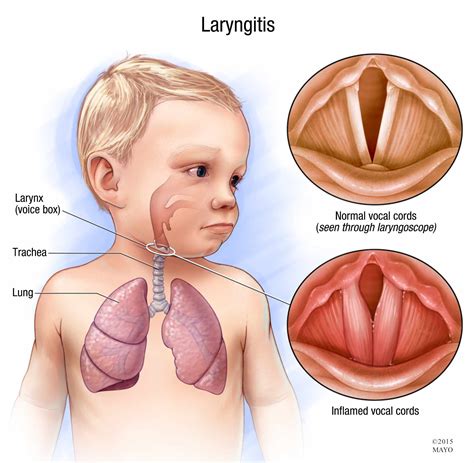 What is laryngitis? - Mayo Clinic News Network