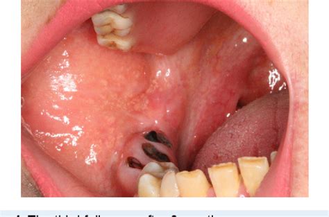 Figure 4 from Removal of an Extra-large Irritation Fibroma With a ...