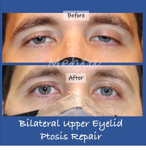 Ptosis Surgery DC | How to Fix Droopy Eyelids | Washington Eye