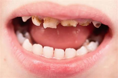 Children's rotten teeth cost hospitals £35m per year - North Street Dental