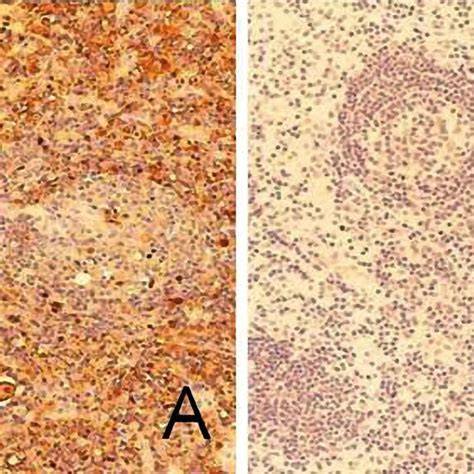 Immunohistochemistry findings. A cervical lymph node biopsy specimen ...