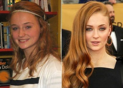 Sophie Turner Plastic Surgery Before and After | Plastic surgery ...