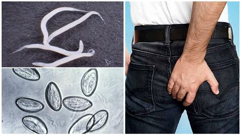 The difference between ascaris, pinworms and other worms, symptoms and ...