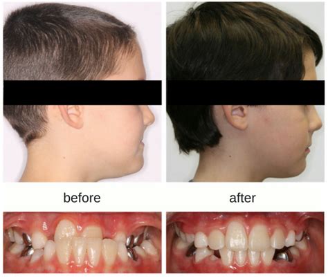 Before And After Braces Underbite