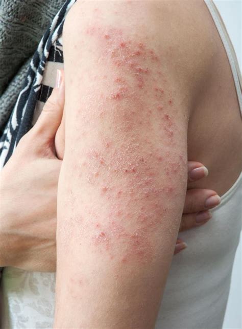 What Is a Diabetic Rash? (with pictures)