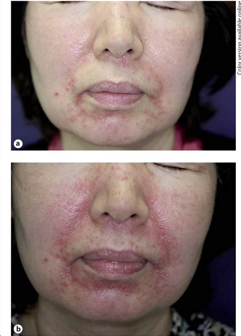 Tacrolimus-Induced Rosacea-Like Dermatitis: A Clinical Analysis of 16 Cases Associated with ...